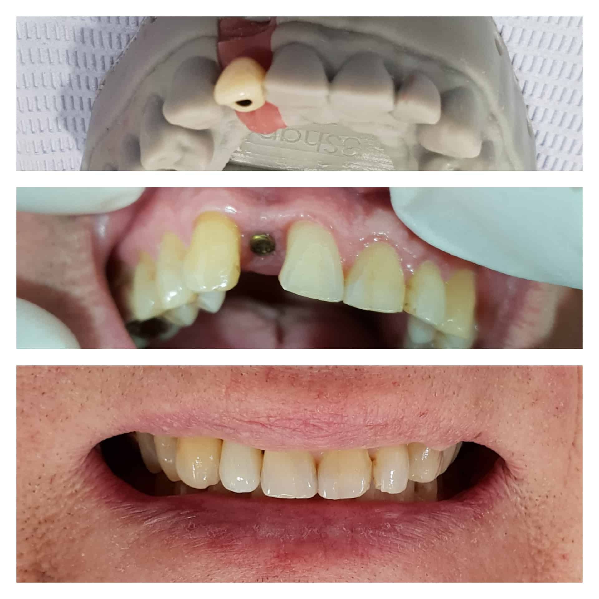Options for Replacement of Missing Teeth Gentle Dental Centre