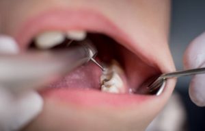 dentist filling cost