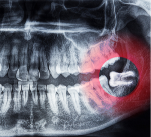 Wisdom Teeth Removal Perth